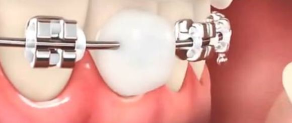 矫正牙齿后经常口腔溃疡怎么办,牙齿矫正口腔溃疡最快解决方法