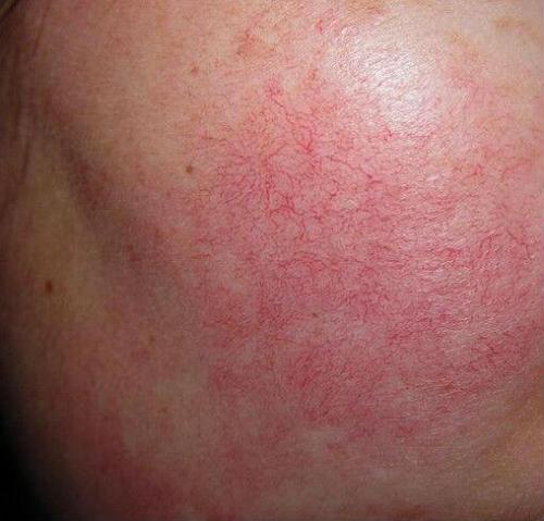 修复泛红红血丝最好的方法,修复红血丝的最快有效方法