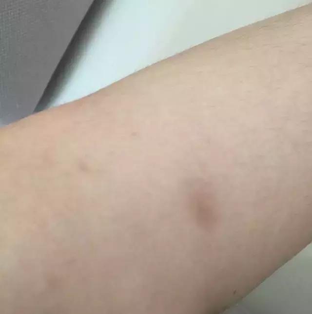 祛疤膏真的去不了增生吗,疤痕三四年了用祛疤膏能淡化吗