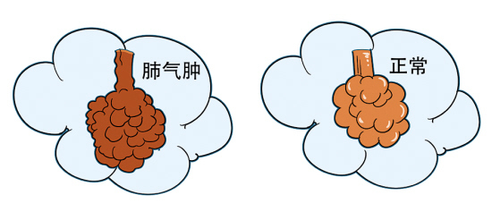 舒利迭治疗肺气肿的效果,补肺丸对治疗肺气肿效果如何