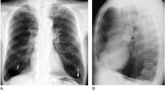 舒利迭治疗肺气肿的效果,补肺丸对治疗肺气肿效果如何
