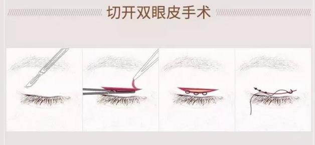 好看的双眼皮必须具备以下几点,真正做的好看的双眼皮是什么样子