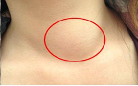 甲减患者会出现精神抑郁是真的吗,甲减为什么容易抑郁