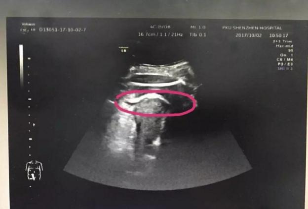 胎儿踢破子宫卡在妈妈肚子里,胎儿一脚踢破子宫怎么回事