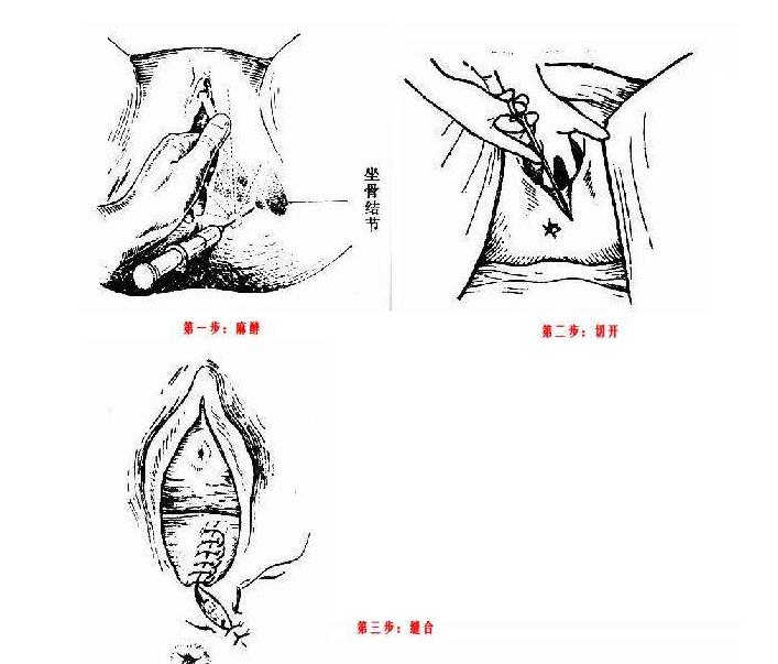 会阴侧切真的每孕妈都需要吗？会有什么后遗症吗？