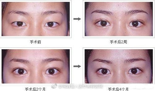 好看的双眼皮必须具备以下几点,真正做的好看的双眼皮是什么样子