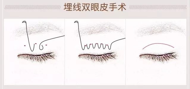 好看的双眼皮必须具备以下几点,真正做的好看的双眼皮是什么样子