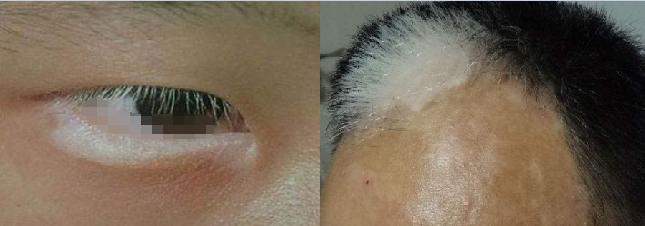 白癜风处的毛发变白多久能恢复,儿童头部白癜风毛发变白能治好吗