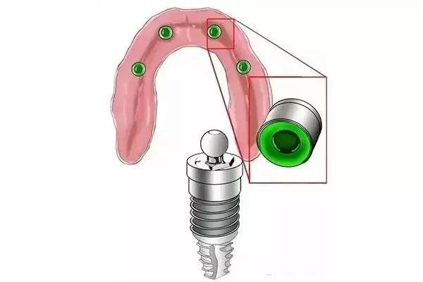 缺牙是种植牙还是烤瓷牙好,烤瓷牙和种植牙哪个保持时间长