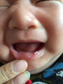 得了鹅口疮怎么办,为什么脚气会影响孩子得鹅口疮