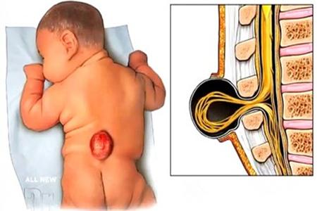 警惕！预防宝宝患上脊柱裂