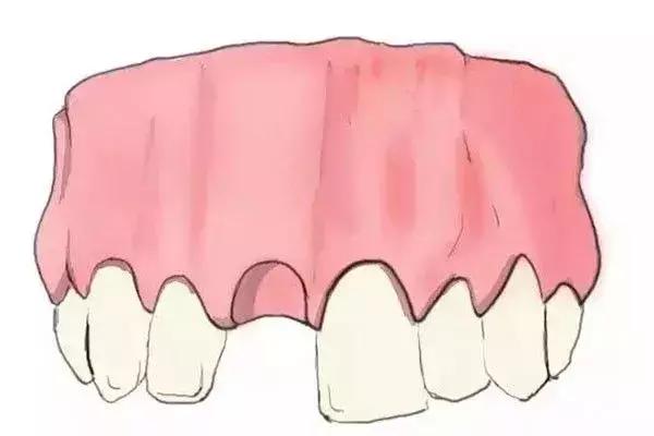 缺牙是种植牙还是烤瓷牙好,烤瓷牙和种植牙哪个保持时间长