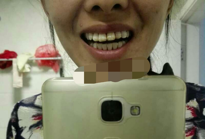 比较有效的牙齿美白方法,你需要知道的牙齿美白小窍门