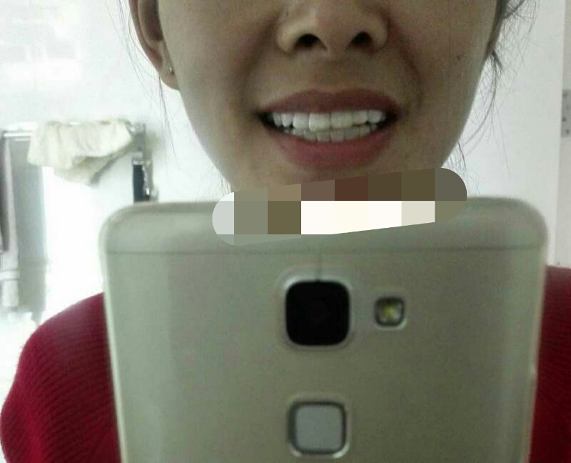 比较有效的牙齿美白方法,你需要知道的牙齿美白小窍门