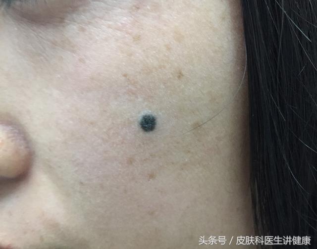 一公分的痣可以做手术切除吗,去医院医生说痣太大了只能做手术