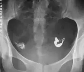 输卵管造影有多重要？这些你都知道吗？