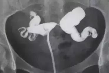 输卵管造影有多重要？这些你都知道吗？