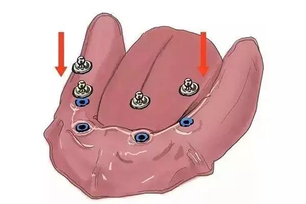 缺牙是种植牙还是烤瓷牙好,烤瓷牙和种植牙哪个保持时间长