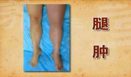 心血管病最怕的三个致命因素,心血管疾病的10个前兆