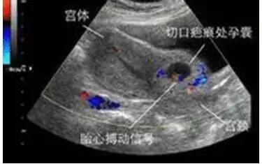 胎儿无影脚,胎儿恐怖成像