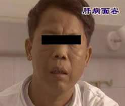 肝硬化是如何变成肝癌的,肝硬化肝癌还需要治疗肝硬化么