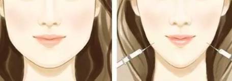 瘦脸针打后悔了怎么做能尽快恢复,瘦脸针人人都可以打吗科普篇