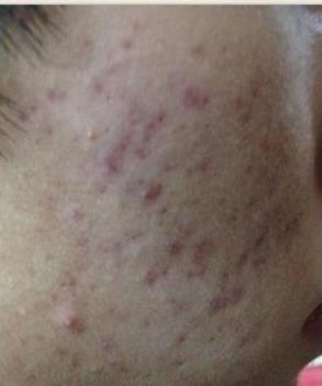 痘痘引发的病变,痘痘肌肤有什么特征