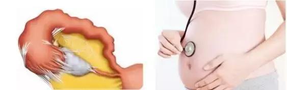 输卵管堵塞宫外孕后还敢怀孕吗,多囊加输卵管堵塞怀孕几率多大