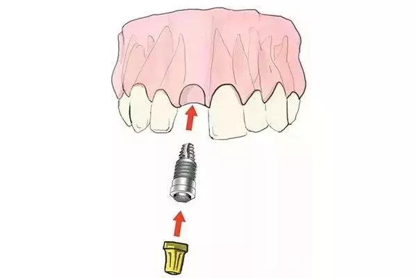 缺牙是种植牙还是烤瓷牙好,烤瓷牙和种植牙哪个保持时间长
