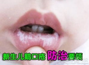 得了鹅口疮怎么办,为什么脚气会影响孩子得鹅口疮