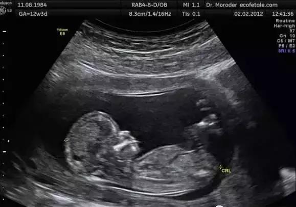 胎儿无影脚,胎儿恐怖成像