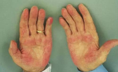 肝硬化是如何变成肝癌的,肝硬化肝癌还需要治疗肝硬化么