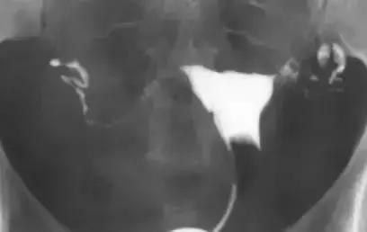 输卵管造影有多重要？这些你都知道吗？