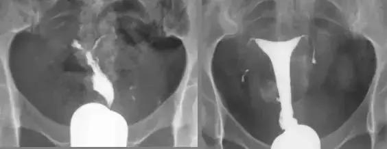 输卵管造影有多重要？这些你都知道吗？