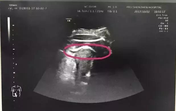 怀孕8月,胎儿竟一脚“踢”破子宫!原来是它惹的货!