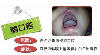 得了鹅口疮怎么办,为什么脚气会影响孩子得鹅口疮