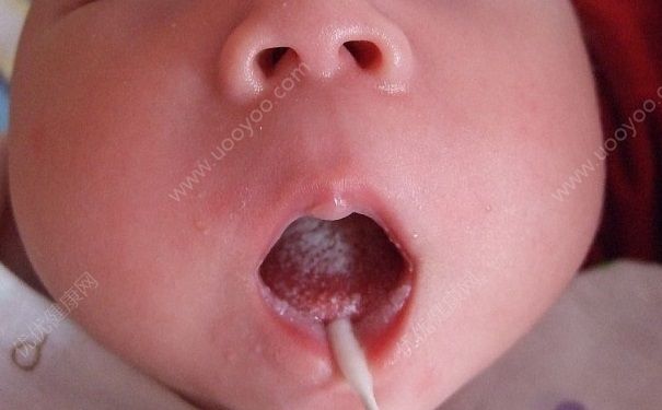 得了鹅口疮怎么办,为什么脚气会影响孩子得鹅口疮