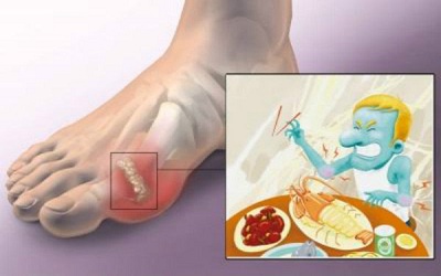 喝啤酒后痛风突然发作怎么办,痛风突然发作怎么解决