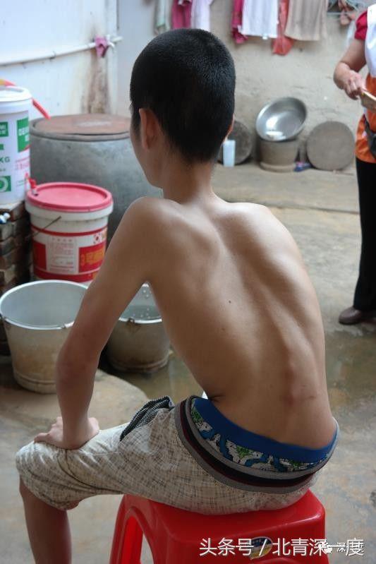 罕见病300万一年,300万一年的罕见病