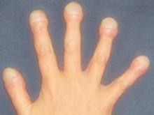 肝硬化是如何变成肝癌的,肝硬化肝癌还需要治疗肝硬化么