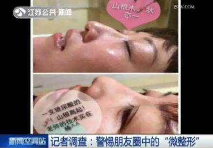 瘦脸针打后悔了怎么做能尽快恢复,瘦脸针人人都可以打吗科普篇