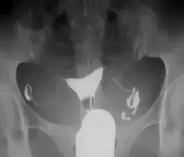 输卵管造影有多重要？这些你都知道吗？