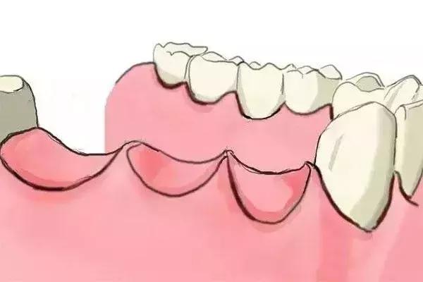 缺牙是种植牙还是烤瓷牙好,烤瓷牙和种植牙哪个保持时间长