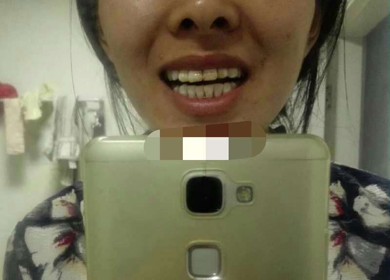 比较有效的牙齿美白方法,你需要知道的牙齿美白小窍门