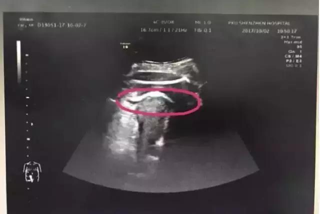 胎儿无影脚,胎儿恐怖成像