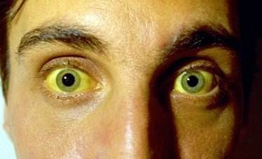 肝硬化是如何变成肝癌的,肝硬化肝癌还需要治疗肝硬化么