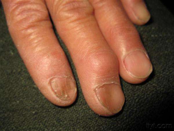 肝硬化是如何变成肝癌的,肝硬化肝癌还需要治疗肝硬化么