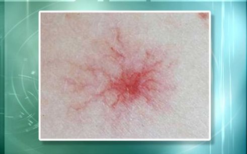 肝硬化是如何变成肝癌的,肝硬化肝癌还需要治疗肝硬化么