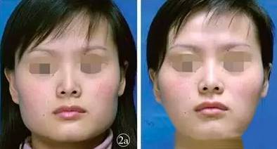 瘦脸针打后悔了怎么做能尽快恢复,瘦脸针人人都可以打吗科普篇