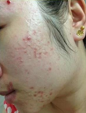 痘痘引发的病变,痘痘肌肤有什么特征